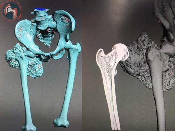 Lần đầu tiên tại Việt Nam ghép thành công xương đùi nhân tạo in 3D