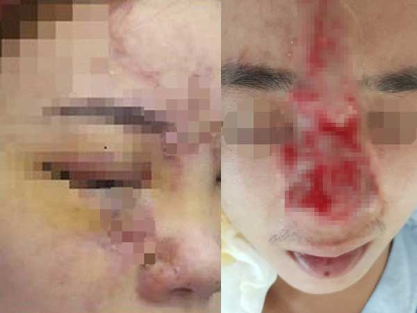 Ham làm đẹp như chị em, người đàn ông có nguy cơ mù mắt do tiêm filler