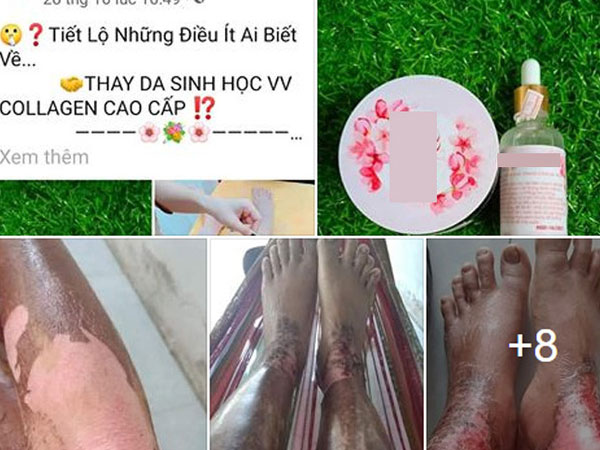 Mua dung dịch lột da trên mạng để có làn da trắng sáng, cô gái lĩnh hậu quả kinh hãi khi da toàn thân như bỏng axit: Trước khi tiến hành lột da cần nhớ điều gì?