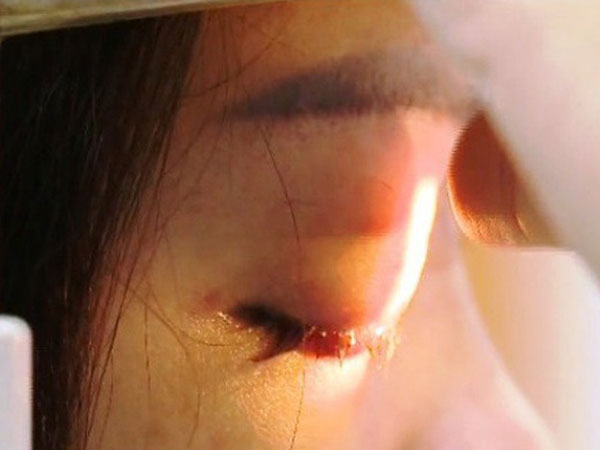 Mù mắt do tiêm filler tại hàng… sửa móng tay