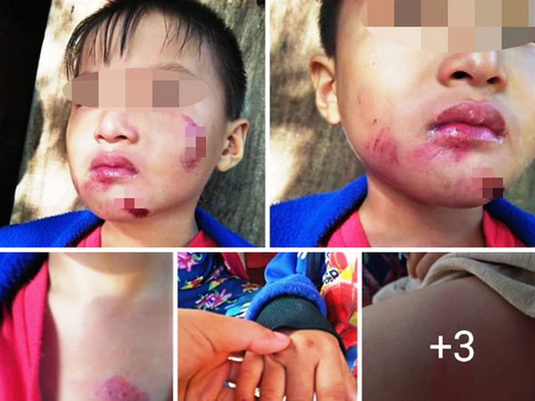 Bé trai 6 tuổi nghi bị chính mẹ ruột bạo hành dã man