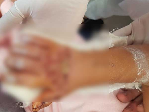 6 giờ đồng hồ căng thẳng, bằng phẫu thuật vi phẫu bác sĩ nối bàn tay phải đứt gần rời cho bé gái 3 tuổi