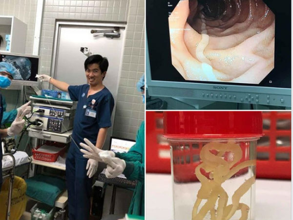 Kinh hãi hình ảnh sán dây bò dài cả mét kéo ra từ bụng bệnh nhân, hãy cảnh giác khi ăn những món khoái khẩu này!