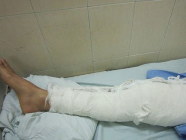 Bị tai nạn gãy xương sườn, người đàn ông bất ngờ tử vong sau khi uống thuốc điều trị