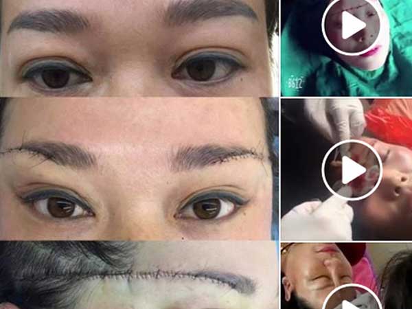 Những hình ảnh rạch da đầu bóc mỡ nâng chân mày, nâng mí sụp, tiêm filler nâng mũi cùng lúc khiến nhiều người kinh hãi
