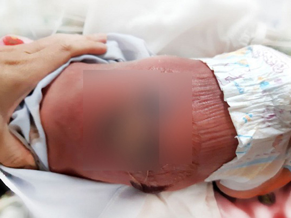 Nằm than sưởi ấm, trẻ sơ sinh bị bỏng nặng dẫn đến nhiễm trùng máu
