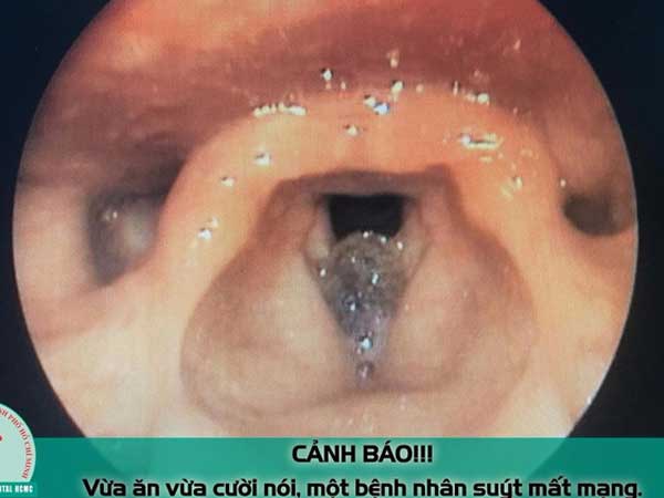 Ăn ốc len xào dừa, một bệnh nhân nhập viện khẩn cấp do khó thở