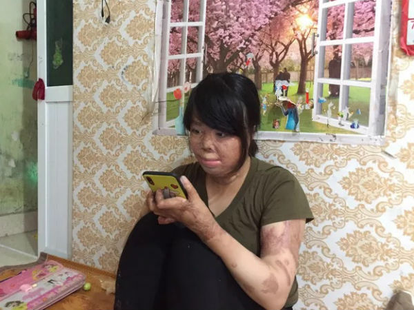 Hành trình tìm lại cuộc sống của người phụ nữ bị chồng tẩm xăng đốt