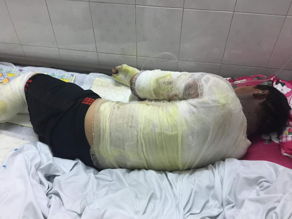 Nổ can đựng xăng, hai vợ chồng nguy kịch