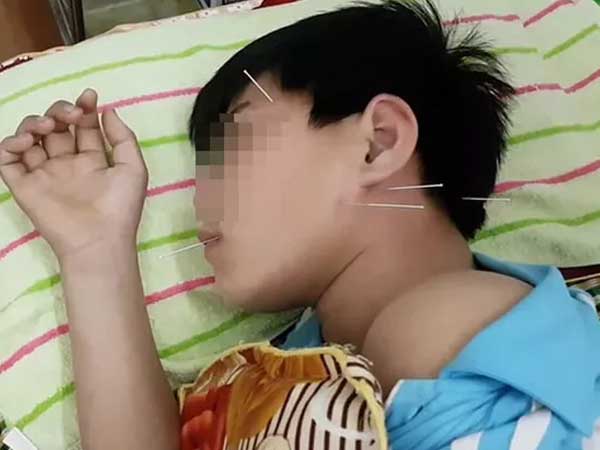 Liệt dây thần kinh số 7 ở trẻ nhỏ, đừng làm điều này nếu không muốn hại con