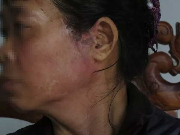 Nỗi đau của người vợ bị chồng nhẫn tâm hắt nước sôi vào mặt
