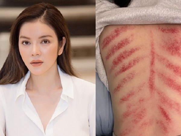 Lý Nhã Kỳ gây 'sốc' khi đăng ảnh tấm lưng đầy vết đỏ rợn người