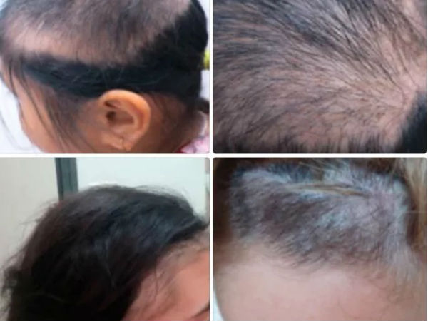 Hoang mang con gái 9 tuổi nhổ trụi mảng tóc, mẹ khóc khi biết nguyên nhân từ chính mình