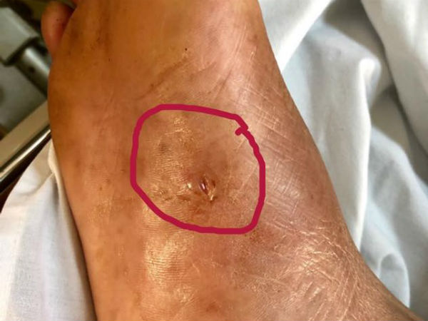 Chỉ với vết thương nhỏ xíu này nhưng nếu bạn không xử lý kịp thời thì có thể dẫn đến suy hô hấp, ngừng thở
