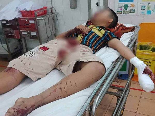 Bé trai bị thương nặng vì làm pháo tự chế bằng bột diêm