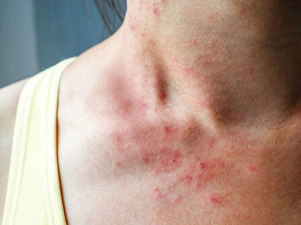 Cẩn thận với nguy cơ mắc bệnh tiểu đường trong dịp Tết nếu bạn gặp phải 2 triệu chứng ngứa từ cơ thể