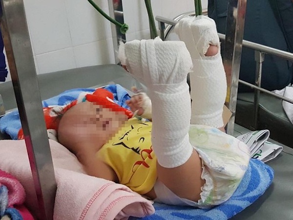 Cha 'ngáo đá' đánh con trai 4 tháng tuổi gãy hai chân, xuất huyết não