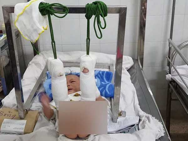 Bé trai 4 tháng bị gãy chân, xuất huyết não: Hai bố mẹ đều là con nghiện?