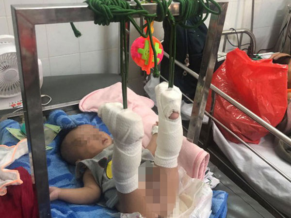 Thông tin mới nhất về sức khỏe của bé 4 tháng tuổi bị bố đánh gãy chân, xuất huyết não