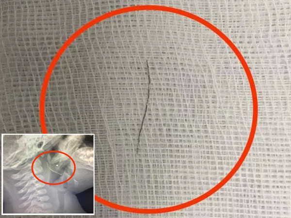 Mua cháo từ cửa hàng ăn, bé trai 13 tháng tuổi bị sợi thép đâm vào cổ họng