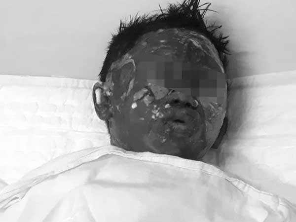 Cháu bé 6 tuổi bị dì ruột tẩm xăng đốt hiện ra sao?