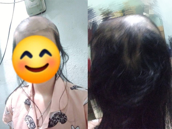 Cứ stress là nhổ tóc khiến đầu hói trụi một mảng, cô gái tiết lộ nguyên nhân phía sau khiến dân mạng không khỏi rùng mình