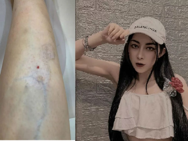 Hot girl bị teo cơ sau xóa sẹo thâm, cảnh báo điều chị em vẫn thích làm