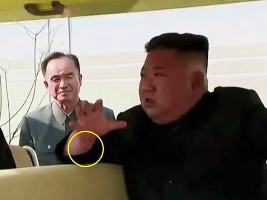 Vết đỏ gây đồn đoán trên cổ tay Kim Jong-un trong ngày tái xuất