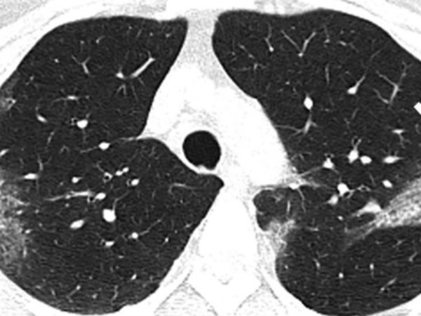 Không chỉ ‘thích’ phổi, virus corona mới còn tấn công hàng loạt nội tạng