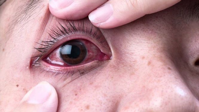 SARS-CoV-2 có thể tồn tại trong mắt người tới 20 ngày