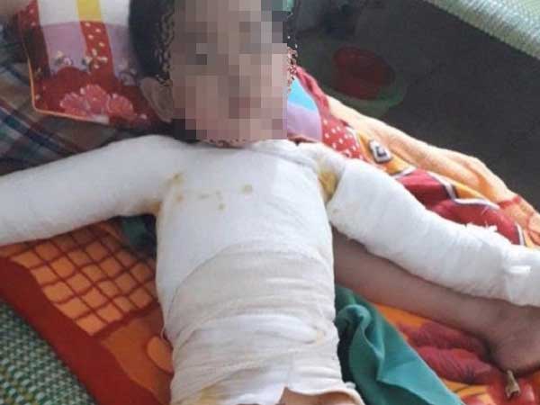 Nghịch bật lửa, bé trai 5 tuổi bị bỏng toàn thân