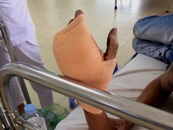 Điện thoại phát nổ, nam thanh niên bị dập nát bàn tay