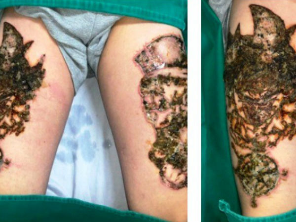Hà Nội: Nam thanh niên 'nát bét' hai đùi vì biến chứng xóa xăm