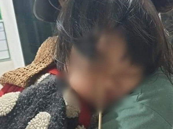 Đang ăn kem thì vấp ngã, bé gái 2 tuổi bị que kem chọc xuyên hốc mắt