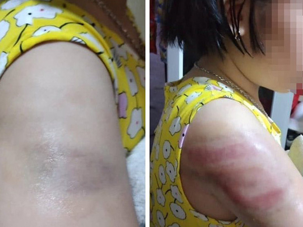 Nam Định: Yêu cầu cô giáo kiểm điểm sau sự việc bé gái bị đánh bầm tím cánh tay vì viết bài chậm