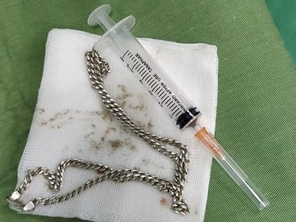 Bé 29 tháng tuổi nuốt cả sợi dây chuyền bạc vào ruột