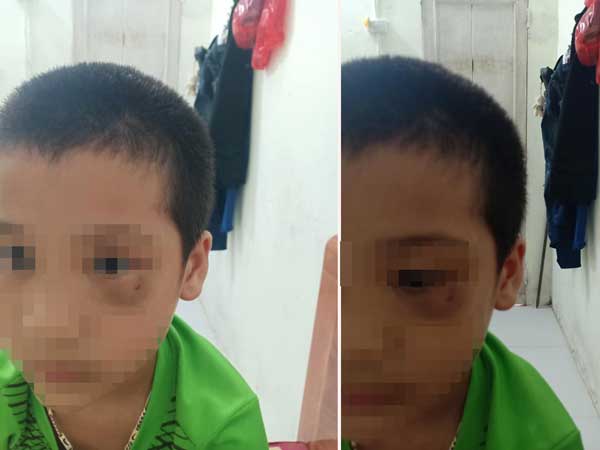Vụ phụ huynh tát trẻ mẫu giáo: Người mẹ chính thức xin lỗi, công khai luôn ảnh đôi mắt bầm tím của con mình
