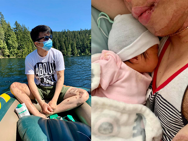 Cuộc sống của Việt kiều Canada sau 1 năm rưỡi bị cắt gân chân và tạt axit: Chào đón 'thiên thần nhỏ' sau quãng thời gian khó khăn