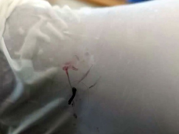 Tá hỏa phát hiện con vắt dài 2cm trong mắt bé trai ở Nghệ An