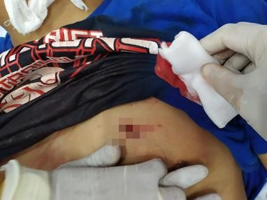 Cứu sống nam thanh niên thủng phổi, ngưng tim nghi bị bạn gái đâm