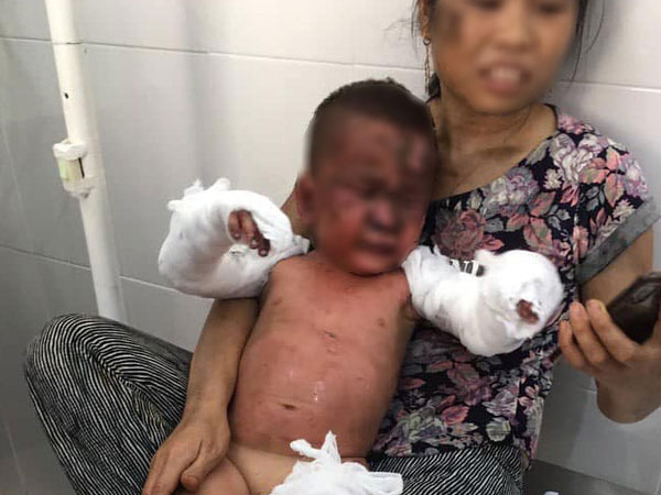 Hai cháu bé bị bỏng nặng sau khi đốt giấy để chơi