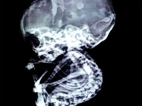 15 năm sau khi phá thai, bà mẹ choáng váng khi phát hiện con vẫn còn trong bụng và hiện tượng bào thai 'hóa đá' hiếm gặp