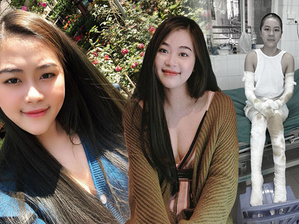 Cô giáo mầm non từng bị bỏng nặng do bóng bay phát nổ ngày khai giảng: 'Nhìn ảnh vậy thôi chứ trên người tôi chằng chịt những vết sẹo không thể xóa mờ'