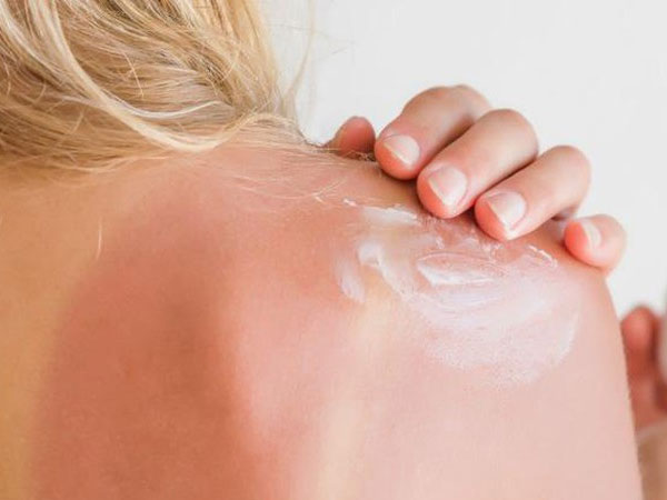 Cách phòng tránh bị bỏng da khi trời nắng cháy