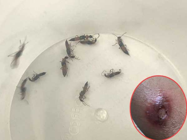 Sinh viên, mẹ bỉm sữa khiếp sợ vì bị kiến ba khoang 'khủng bố' tận giường, làm lở loét da nặng nề