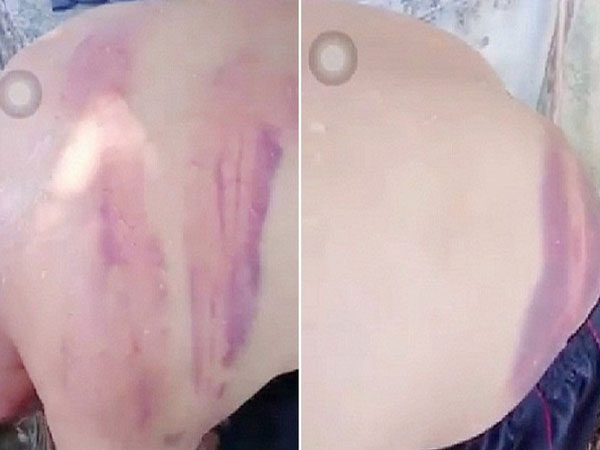 Xác minh vụ người đàn ông bầm tím khắp lưng nghi bị 'vợ hờ' đánh ở Nghệ An