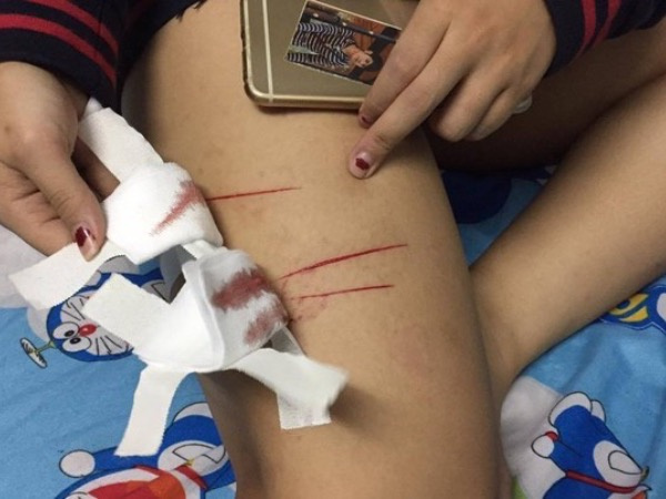 Nữ sinh ở TPHCM bị rạch đùi gây thương tích trên đường đi học về