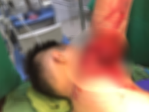 Va phải chân vịt thuyền thúng khi đi tắm biển, bé trai nhập viện nguy kịch