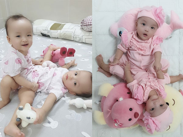 Sẵn sàng cho ca mổ tách dính 2 bé gái 'dùng chung một bỉm' tại BV Nhi Đồng TP.HCM
