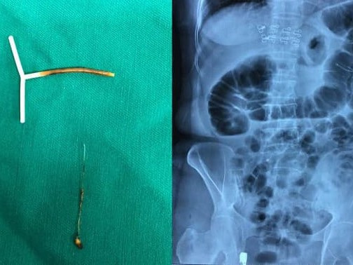 Cứu người phụ nữ bị vòng tránh thai xuyên thủng đại tràng